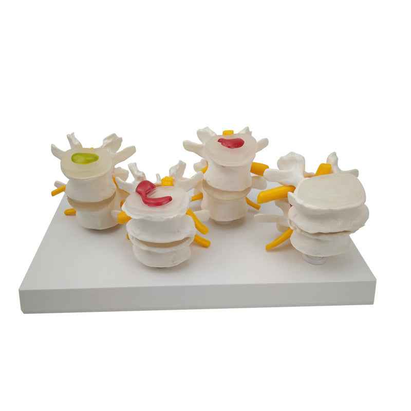 Life-Size 4-Stage Diseased Lumbar Spine Anatomy Model | Herniated Disc & Degeneration Teaching Equipment