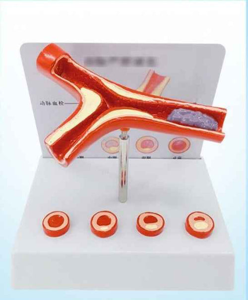 3D Vascular Anatomy & Atherosclerosis Teaching Model – 4-Stage Artery Comparison Display