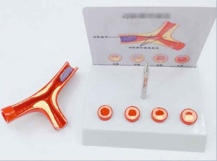 3D Vascular Anatomy & Atherosclerosis Teaching Model – 4-Stage Artery Comparison Display