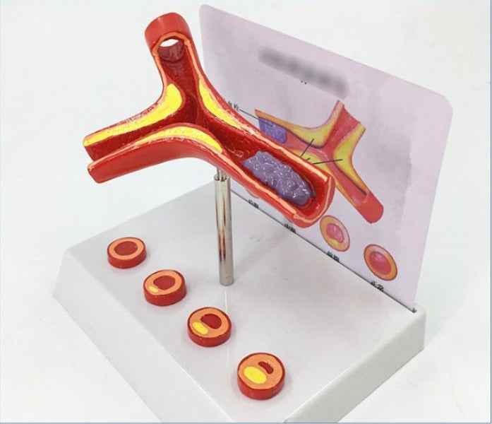 3D Vascular Anatomy & Atherosclerosis Teaching Model – 4-Stage Artery Comparison Display