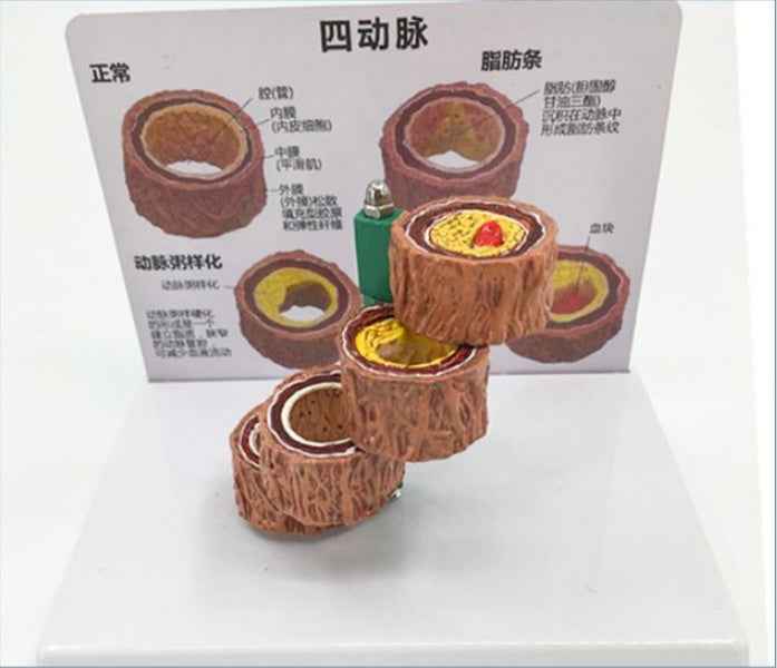 3D Vascular Anatomy & Atherosclerosis Teaching Model – 4-Stage Artery Comparison Display