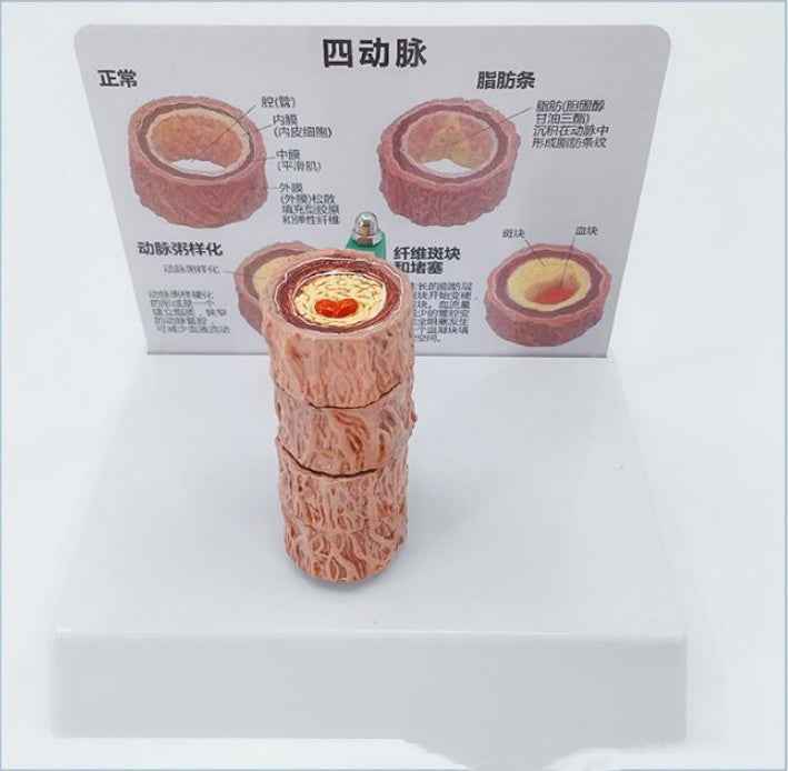 3D Vascular Anatomy & Atherosclerosis Teaching Model – 4-Stage Artery Comparison Display