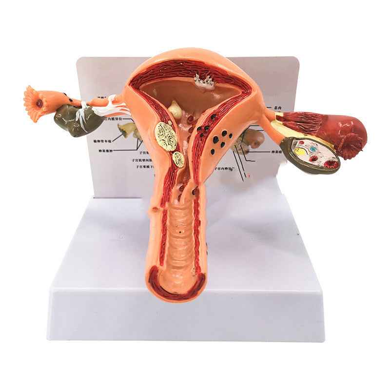 Life-Size Female Pathological Uterus Anatomy Model | Reproductive System Pathology & Disease Teaching Tool