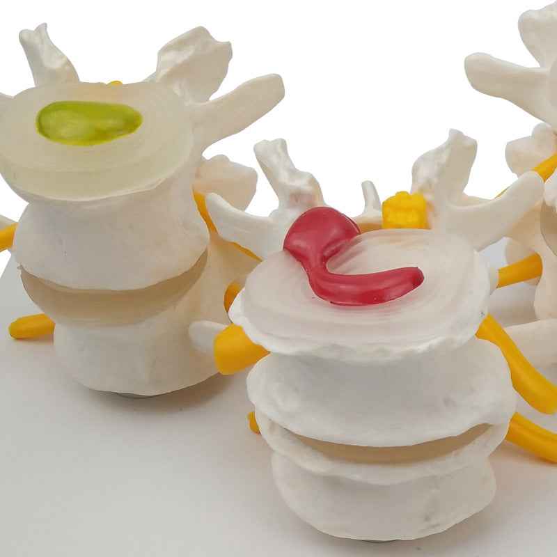 Life-Size 4-Stage Diseased Lumbar Spine Anatomy Model | Herniated Disc & Degeneration Teaching Equipment