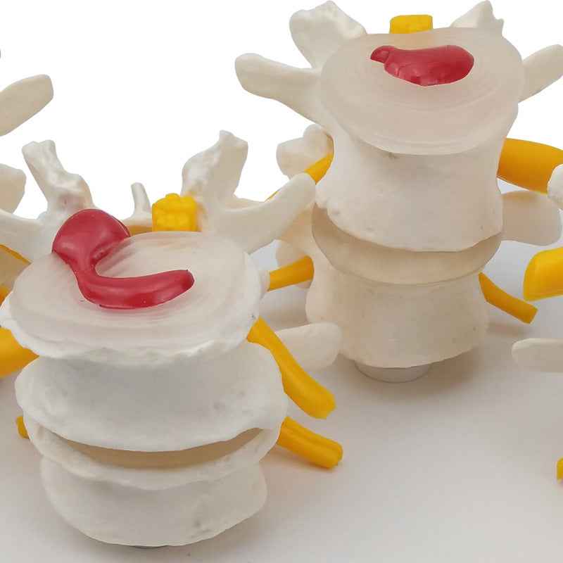 Life-Size 4-Stage Diseased Lumbar Spine Anatomy Model | Herniated Disc & Degeneration Teaching Equipment