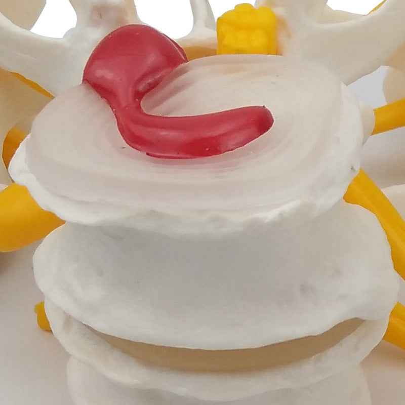 Life-Size 4-Stage Diseased Lumbar Spine Anatomy Model | Herniated Disc & Degeneration Teaching Equipment