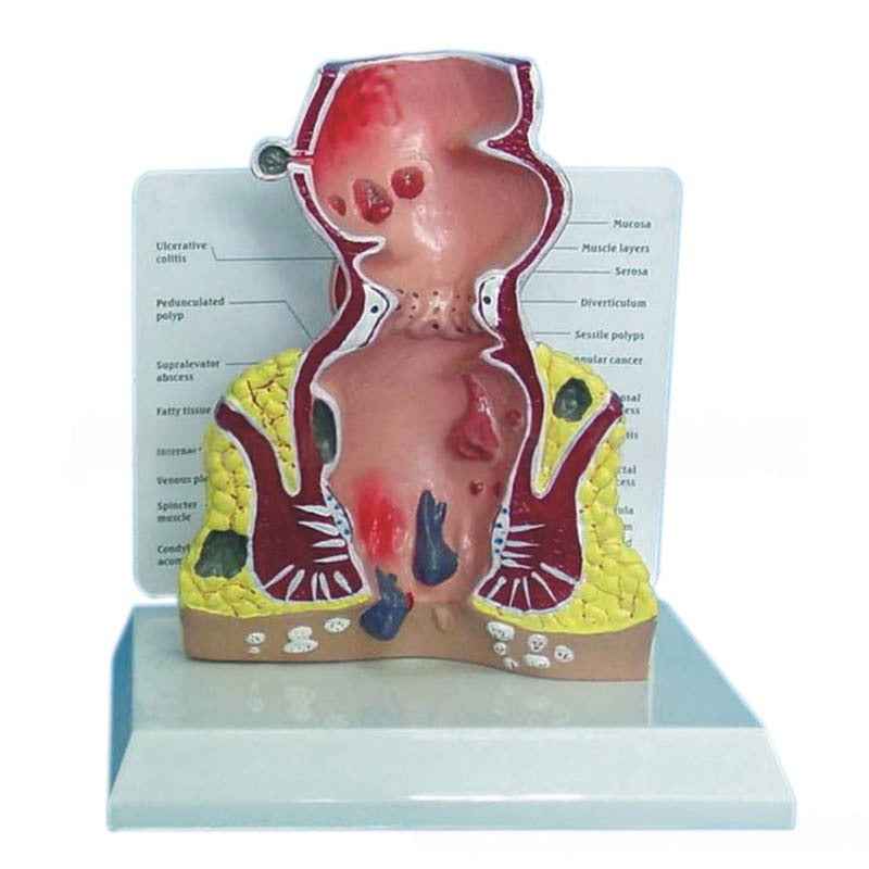Life-Size Human Rectal and Anal Canal Anatomy Model – 1:1 Scale Medical Teaching & Patient Education Tool with Numbered Digital Indicator Signs